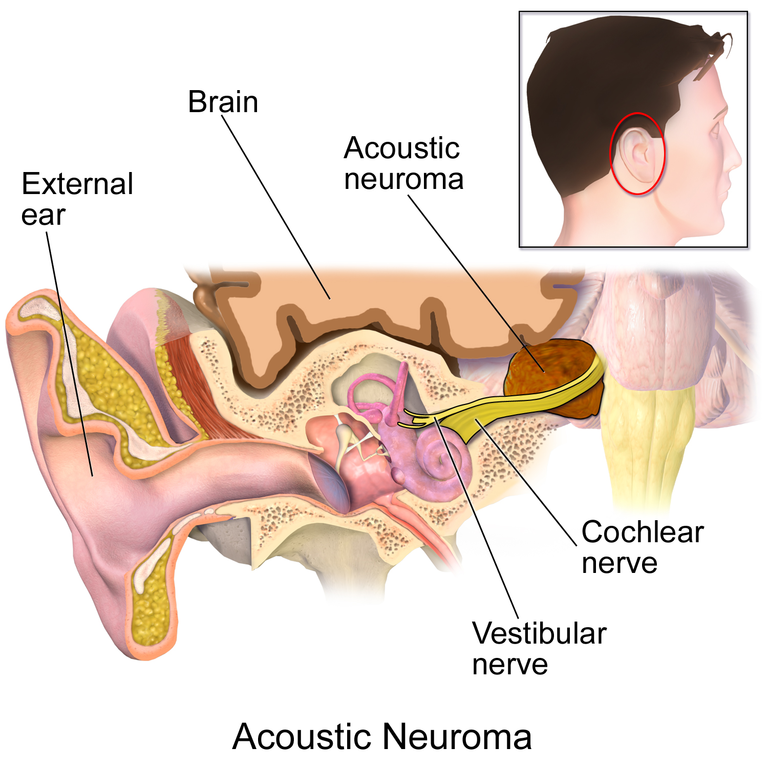 What is an acoustic neuroma?