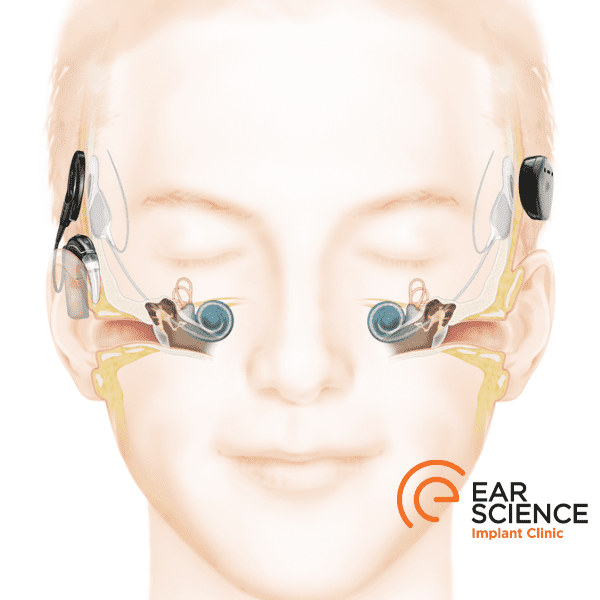 How a cochlear implant works: a diagram of the internal workings and mechanisms of a cochlear implant